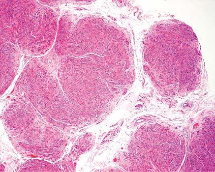 Micronodular microscopic appearance of uterine leiomyoma having