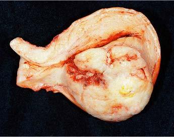 Leiomyosarcoma resulting in a large intramural and
