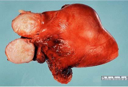 Adenomatoid tumor of uterus. A, Gross appearance.