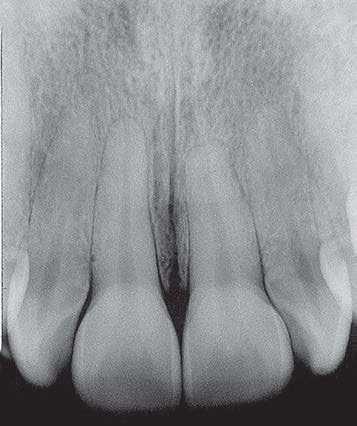 1 mm in the anterior region; coincident maxillary midline, and mandibular midline with a 0.5 mm deviation to the right; 0.