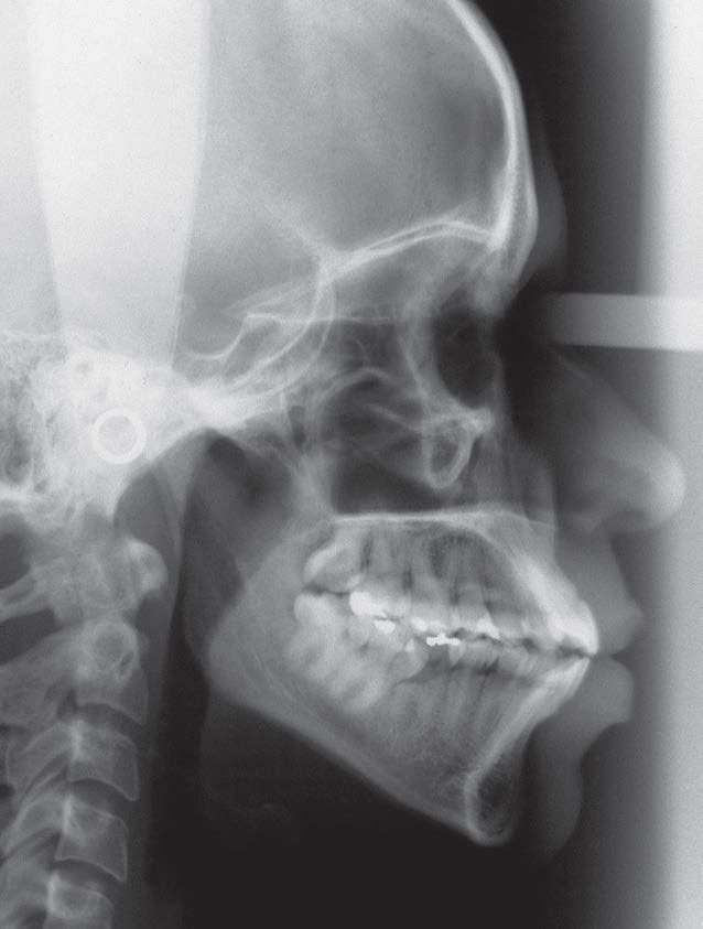 Angle Class I malocclusion with anterior open bite treated with extraction of permanent teeth A B Figure 4 - Initial cephalometric proile radiograph (A) and cephalometric tracing (B).