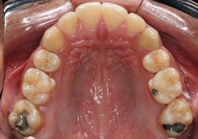 Then, retraction of teeth #33 and #45 began with chain elastics, with the posterior and anterior teeth tied