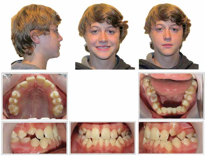 After six months of maxillary-only appliances, no significant mandibular growth had taken place (Figs. 9a c; p. 34).