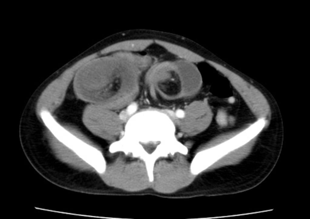 Fig. 7: Ileocecal intussusception in a 34-year-old man with right lower quadrant pain. There was a prior history of anemia.