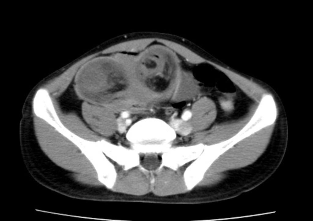 Fig. 8: The anatomopathological diagnosis demonstrates ectopic pancreas