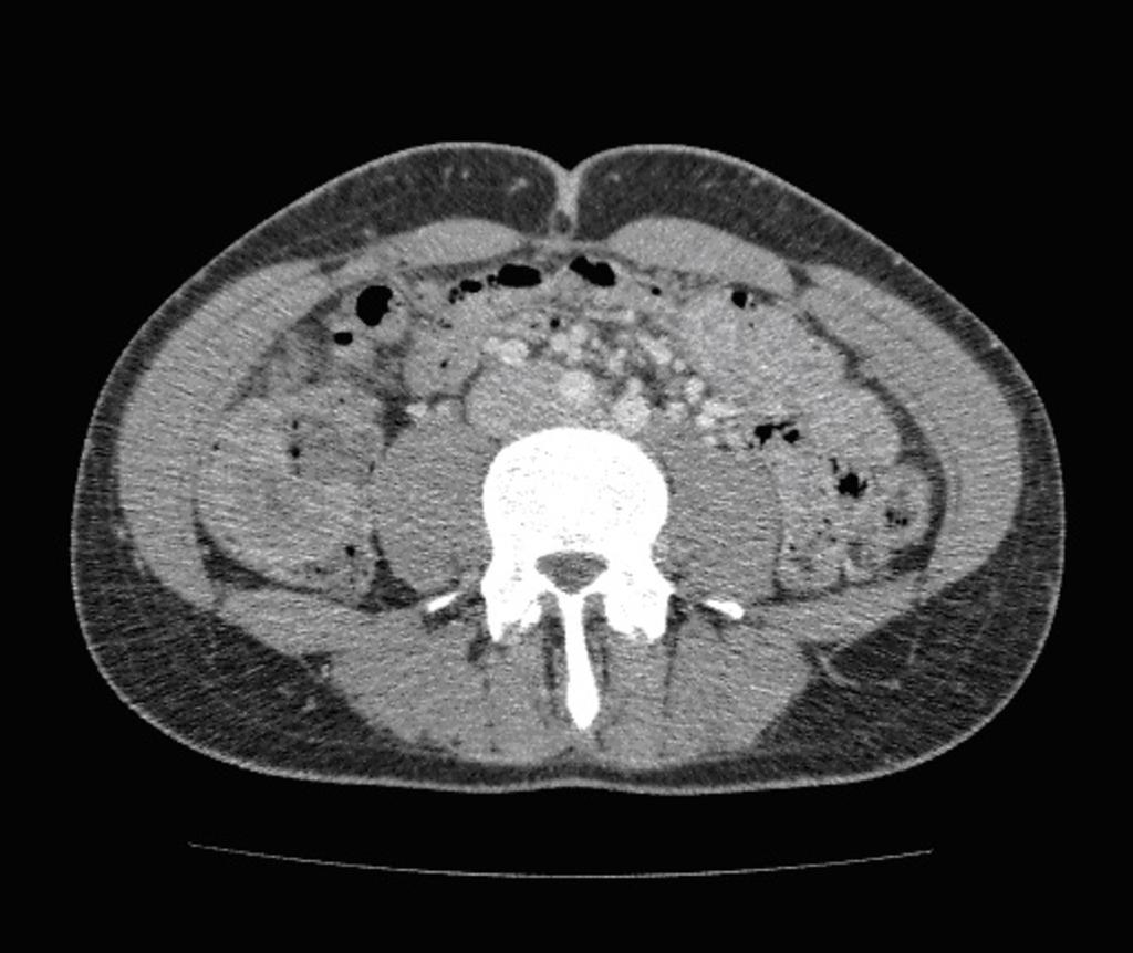 Fig. 9: Ileo-colic intussusception in a 29-year-old man with abdominal pain.
