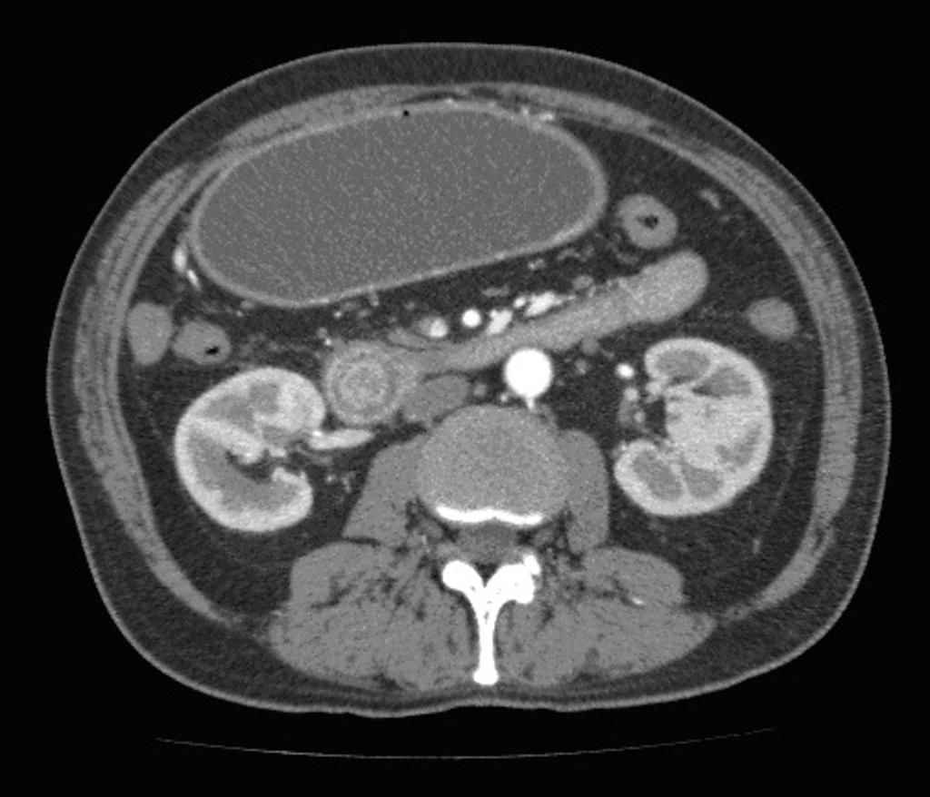 Fig. 10: Duodeno-duodenal intussusception in a 56-year-old man with accute hypogastric pain.