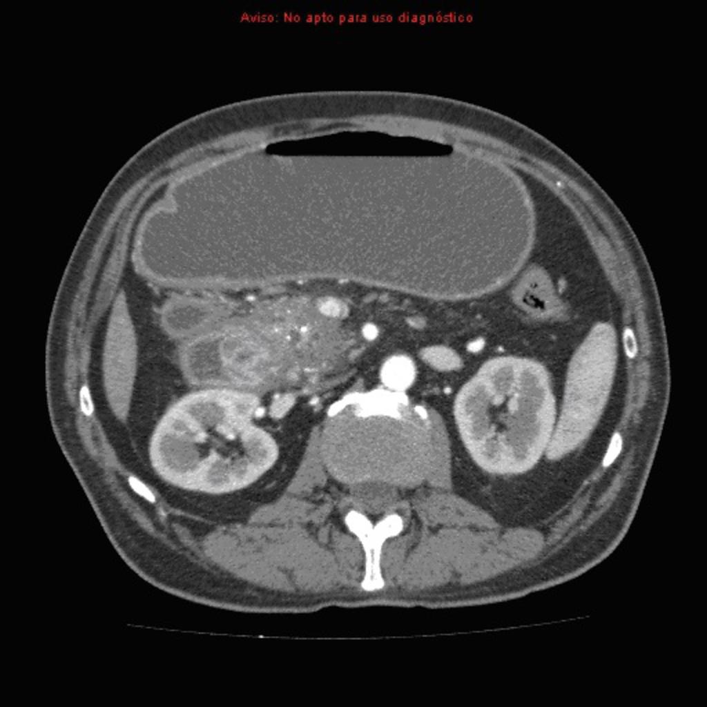 Fig. 11: There is a groove pancreatitis which may mimic a pancreatic head carcinoma.