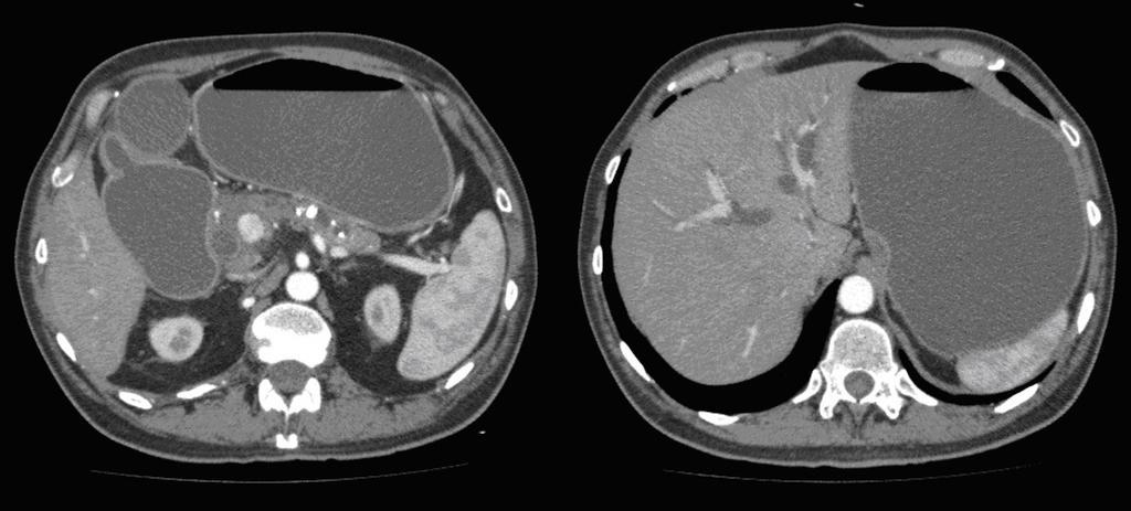 Fig. 12: Upper cross-sectional image shows intra and extrehepatic biliary dilatation (right) and chronic