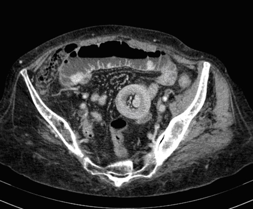 Fig. 13: Ileoileal intussusception in a 75-year-old woman with metastatic melanoma presenting accute left lower quadrant pain.