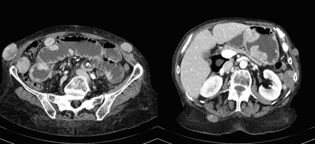 Fig. 14: Multiple large pedunculated polypoid masses in stomach and small bowel, and rounded masses
