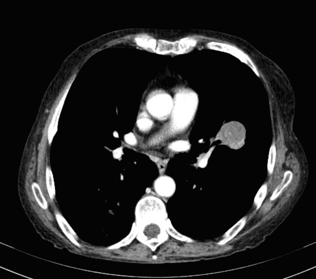 Fig. 15: Note the presence of a heterogeneous mass in left lung. Fig.