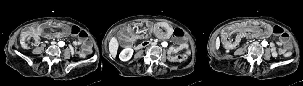 Contrast-enhanced CT scans of the abdomen show the classic finding of a sausageshaped