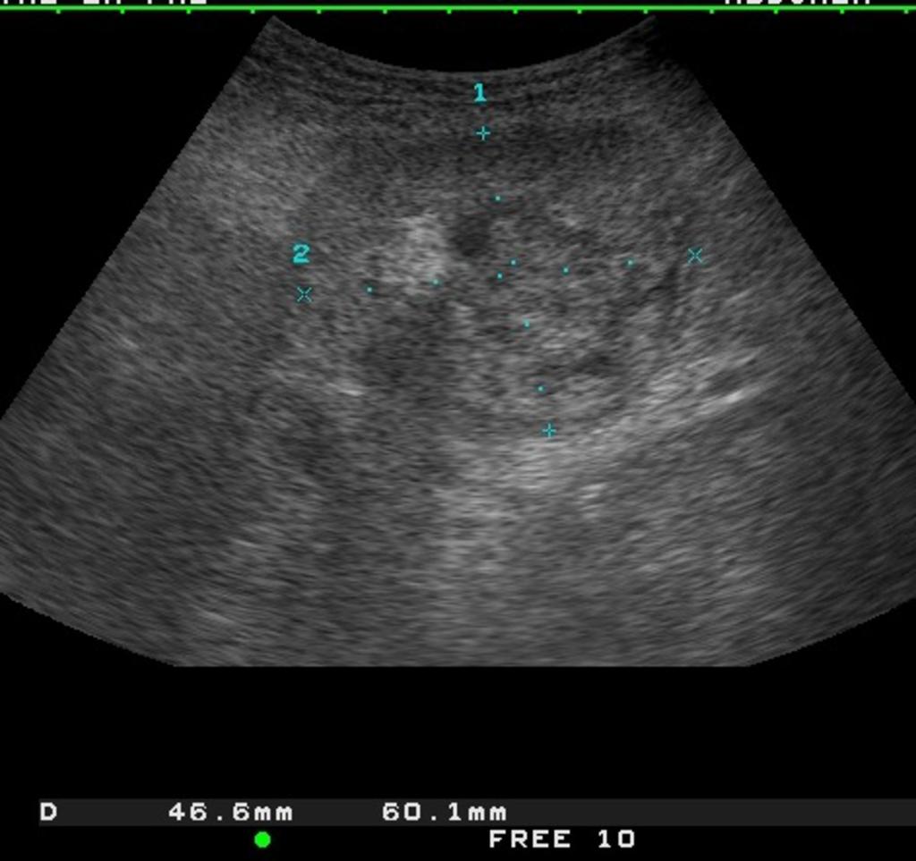 Fig. 19: Axial US scan in a 87-year-old woman with right lower quadrant pain.
