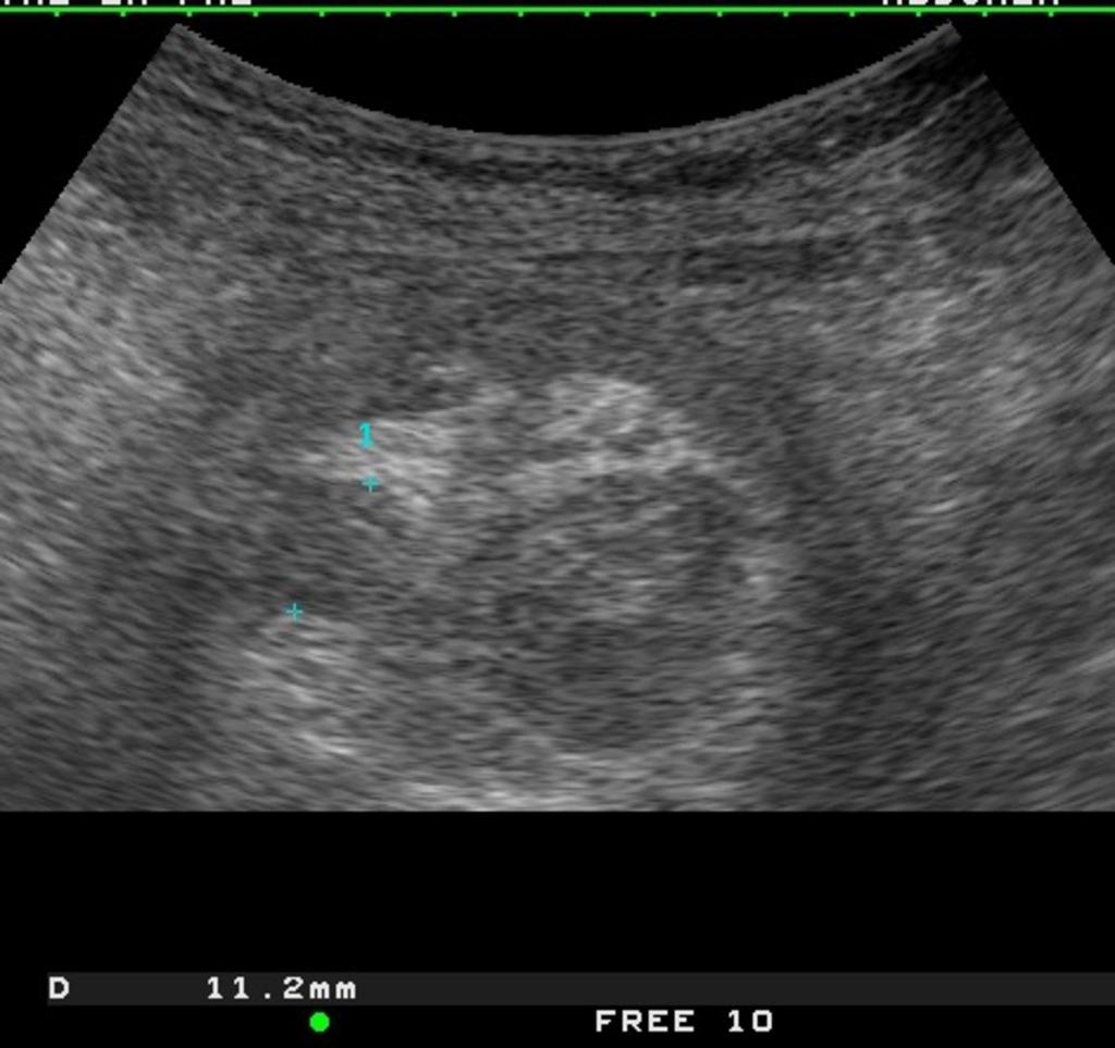 Fig. 20: US scan obtained at the base of the intussusception shows the central limb of the intussusceptum eccentrically surrounded by the