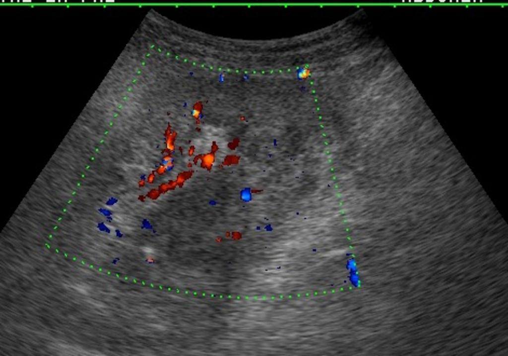 Fig. 21: Doppler US scan show blood flow within