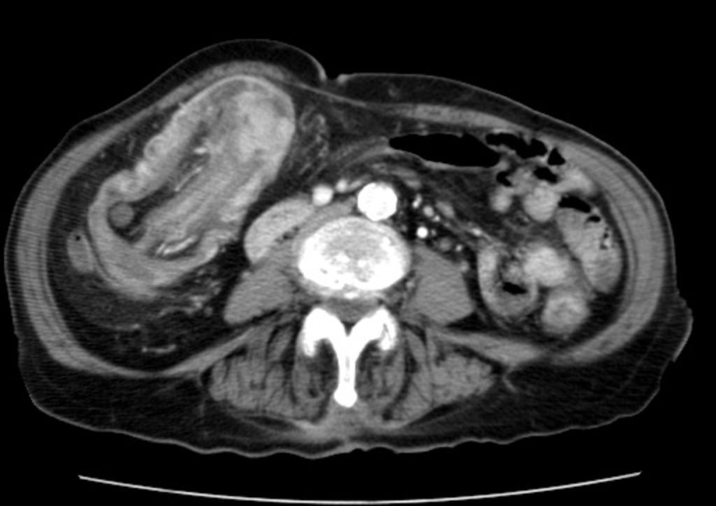 Fig. 22: Ileocolic intussusception secondary to adenocarcinoma in the previous patient.