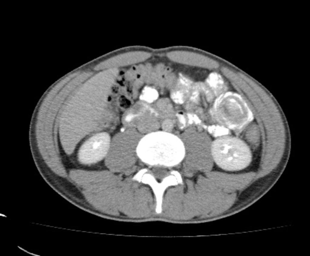Images for this section: Fig. 1: Transient small bowel intussusception in a 27-year-old man with left lower quadrant pain.