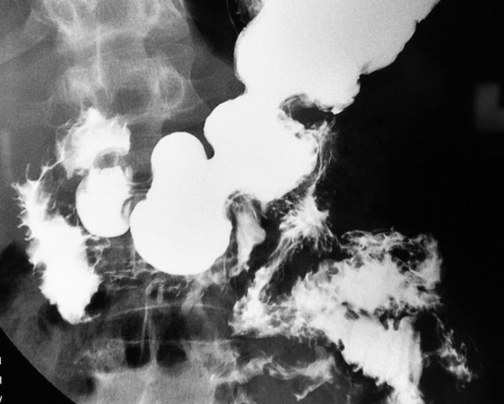 Fig. 4: Anteroposterior radiography from single-contrast barium enema shows delayed