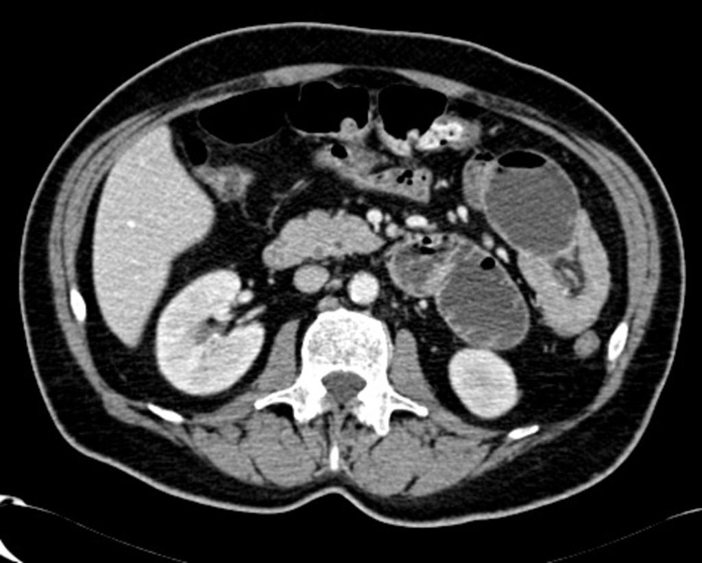 Fig. 5: Enteroenteric intussusception in a 98-year-old woman with abdominal pain and constipation.