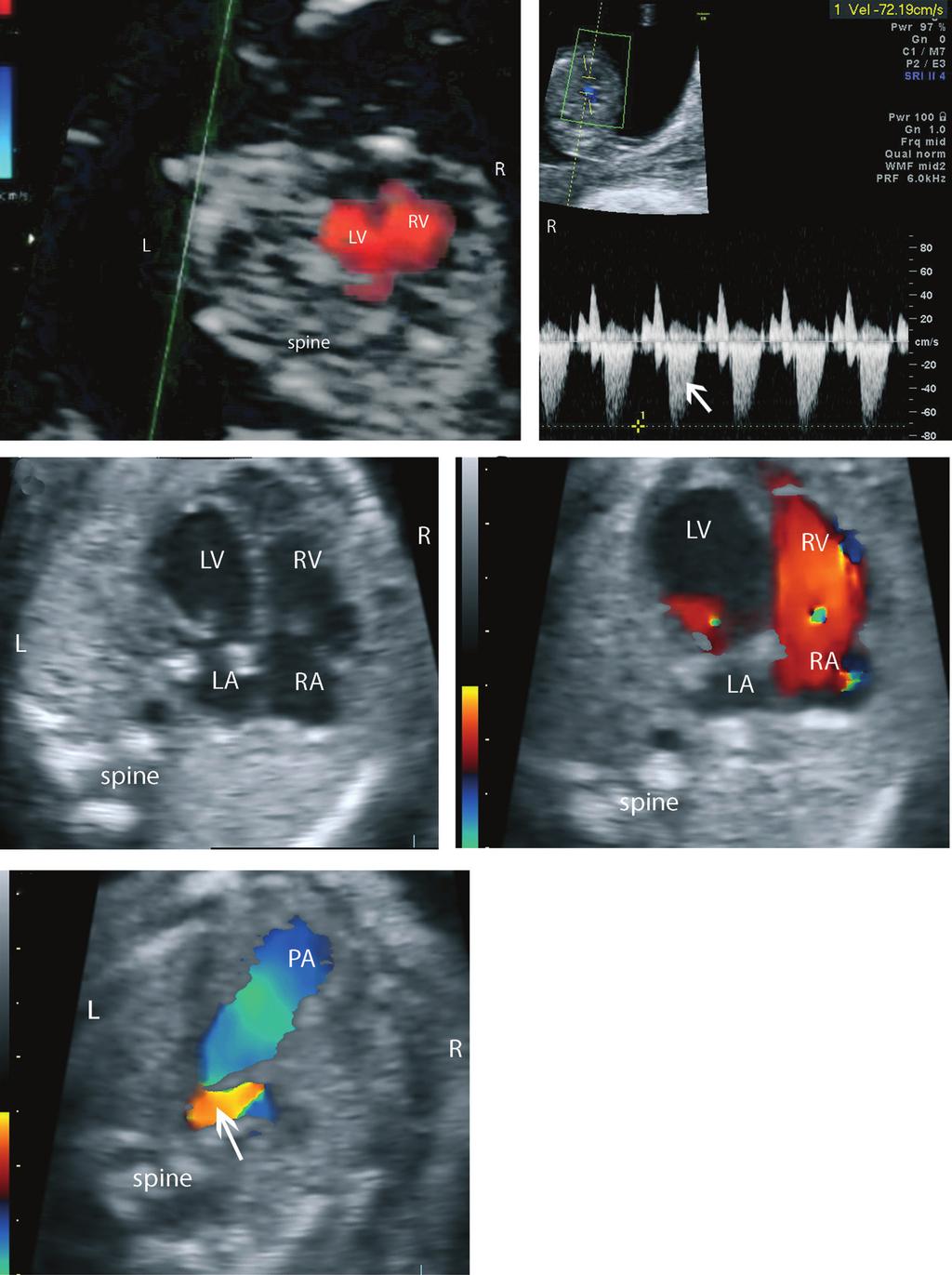 Accuracy of early fetal echocardiography 683 Figure 2 Ultrasound images showing progression from mild to severe aortic stenosis.