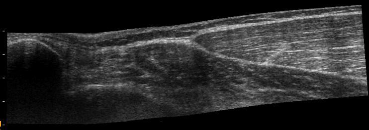 Figure 39: Example of a typical mid-sagittal B-mode ultrasound image of patellar
