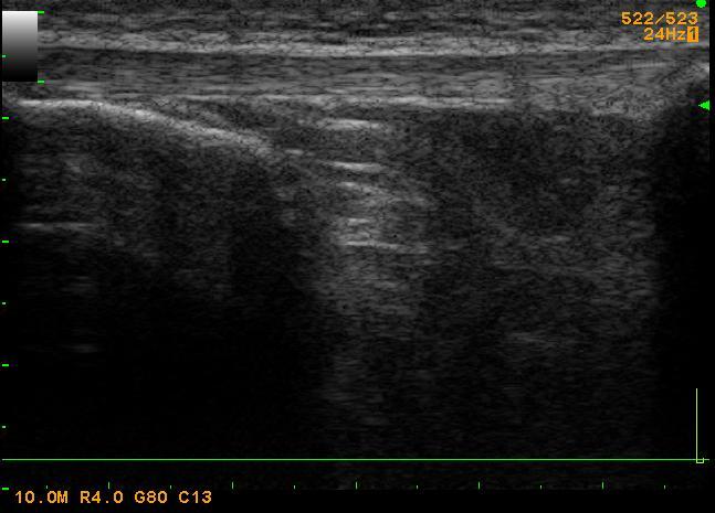 Figure 40: Example of an extended field of view ultrasound image of the