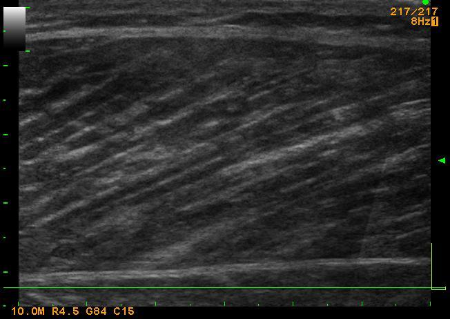 Figure 41: Example of a typical B-mode ultrasound image