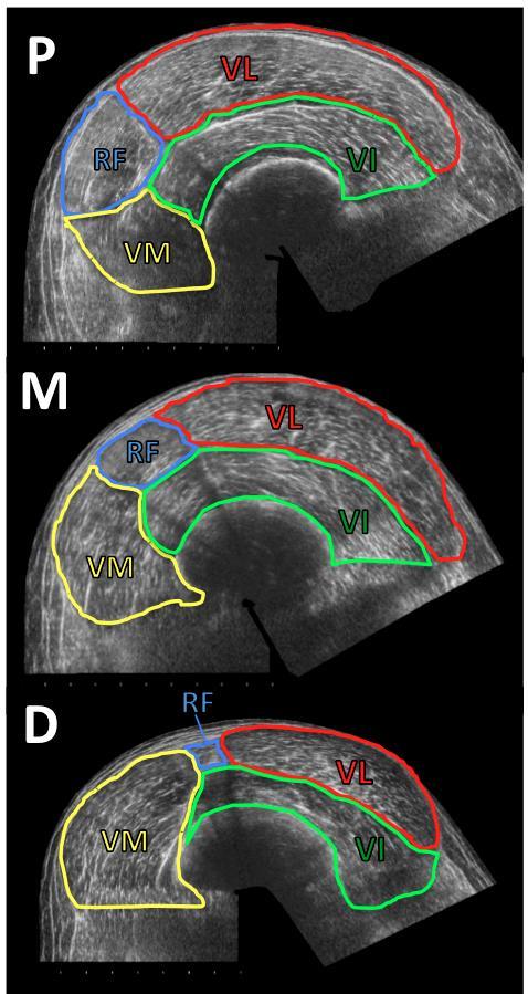 Figure 43: An example of transverse extended field of view ultrasound images of the quadriceps femoris. Images are taken at the distal- (D), mid- (M) and proximal- (P) thigh.