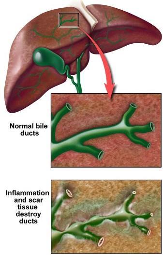 Primary Sclerosing Cholangitis Inflammation and destruction of intrahepatc and