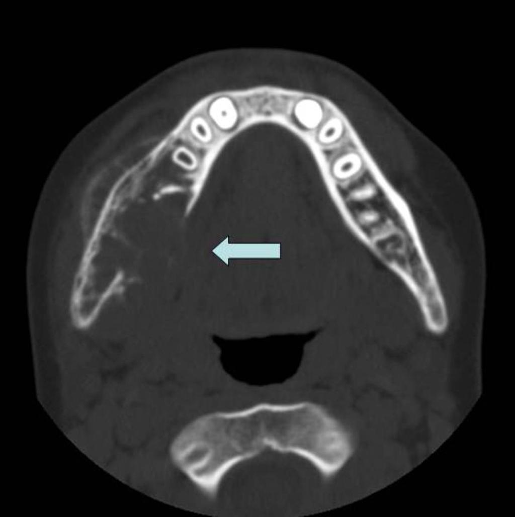 Fig. 0: Ameloblastoma in a 10-year old boiy.