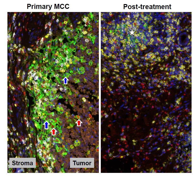 PD-1 Blockade with Pembrolizumab in Advanced Merkel Cell Carcinoma Merkel cell carcinoma 56% response with Merck Pembro viral status, mutation