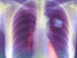 3. Karcinom pluća Najveći broj slučajeva karcinoma pluća nastaje iz stanica pluća. Međutim, karcinom se može također širiti (metastazirati) u pluća iz drugih dijelova tijela.