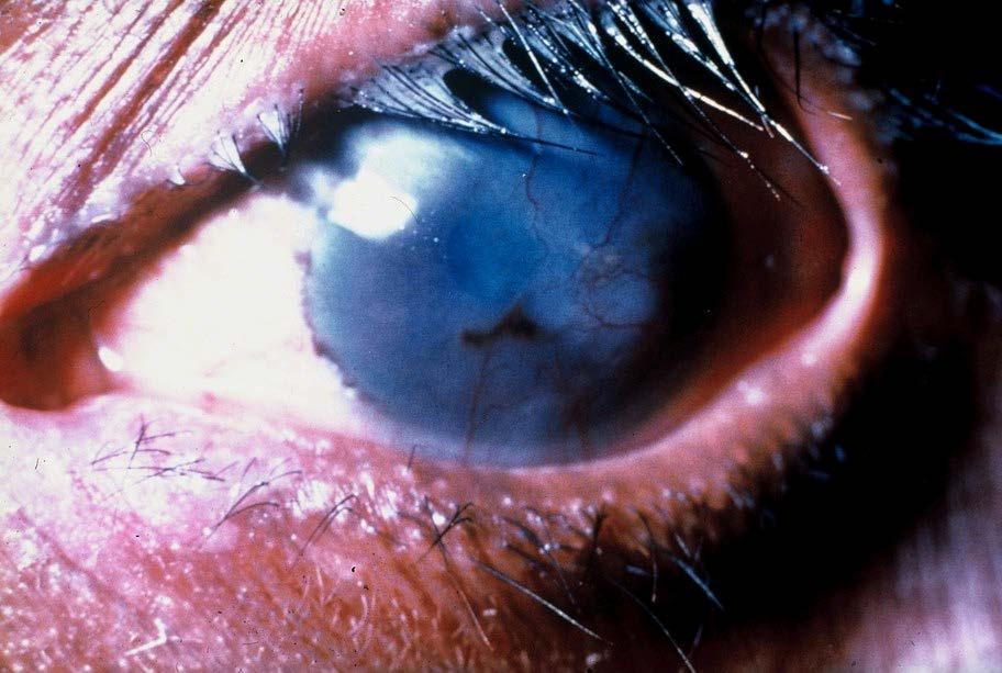 Trichiasis with