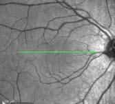 (OCT) of chronic CSCR in humans shows choroidal