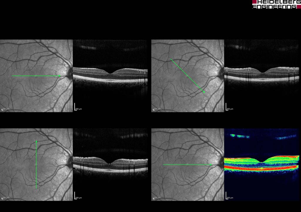 thickness and the different retinal layers.