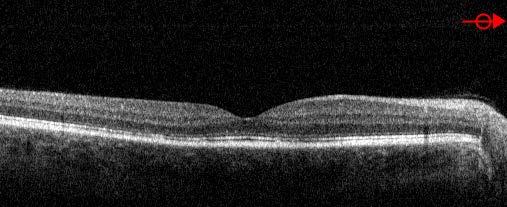 retinal surface (left panels) shows