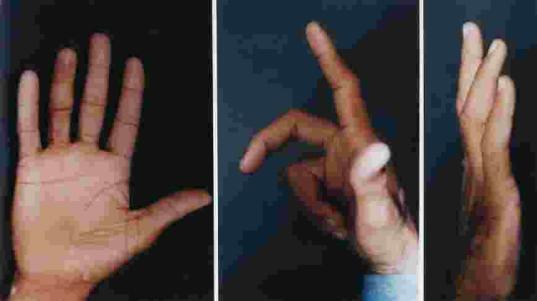 adhesions and ruptures in 0 fingers (%), while excellent to good outcomes were obtained in 3 fingers (8%) when the repair was delayed and performed by trained surgeon familiar with the flexor tendons