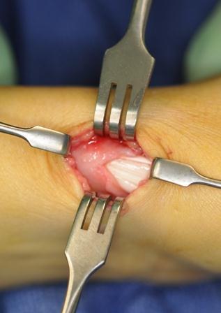 Complications Incomplete release (presence of extensor sub-compartment)