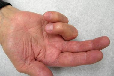 Clinical Presentation Pain over finger (especially over A1 pulley) Swelling Triggering with