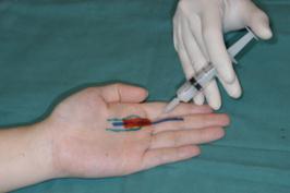 symptoms >6 mths Diminished response noted in patients requiring repeated injections