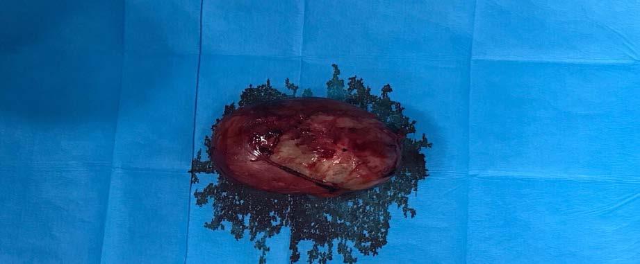 International Journal of Scientific & Engineering Research Volume 9, Issue 4, April-2018 783 Intraoperative photos of our case. 3.