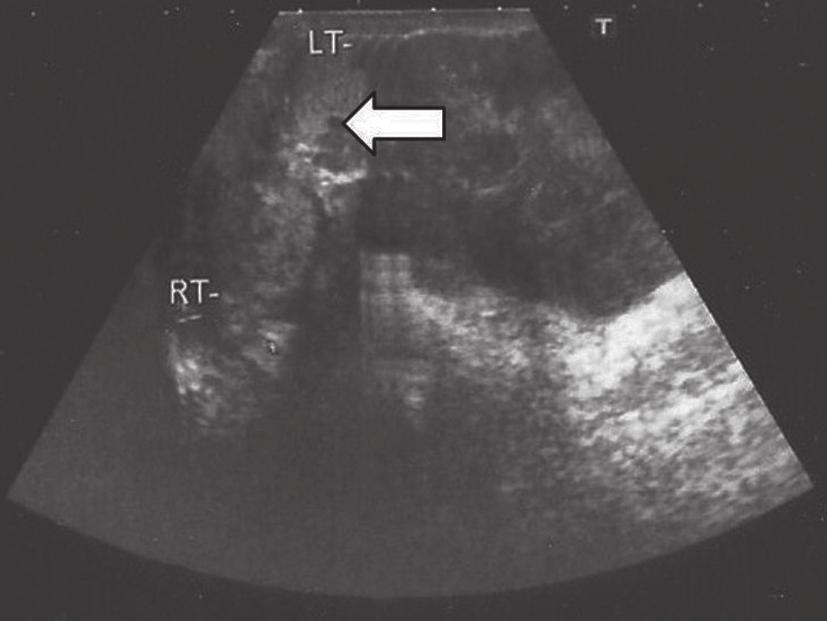 B-mode ultrasound image of the scrotum (axial plane).the left paratesticular mass causes displacement of the ipsilateral testis (arrow), which appears with a slightly heterogeneous echo-pattern.