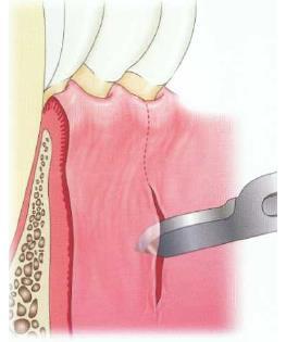 Periodontal flap surgeries