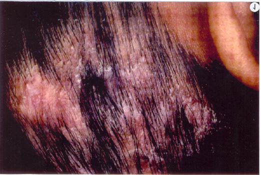 leading to alopecia and scarring. Some zoophilic dermatophytes induce a severe inflammatory and hypersensitivity reaction known as keroin. Hair invasion is of two types (Fig 2): a.