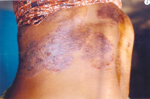 Tinea cruris (Jock itch, Dhobie s itch): Ringworm of inguinal area involving the groin, perianal, perineal areas often involving the upper thigh (Fig 4).
