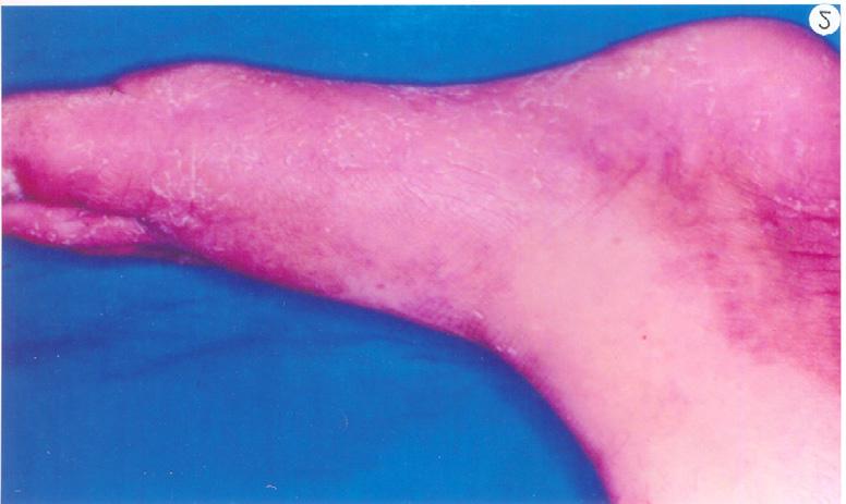 Tinea pedis (Athlete s foot): Ringworm infection of feet involving interdigital webs and sole.