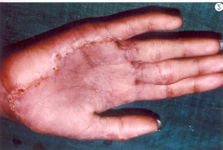 burning (Fig 5). Commonest infecting species are E. floccosum, T. rubrum, T. mentagrophytes. Tinea pedis is common among athletes and office workers.
