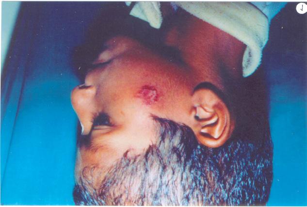 Tinea faciei: Ringworm infection of glabrous skin of face, excluding beard area (Fig 8). Commonest species associated with this disease are T. rubrum, T. mentagrophytes, T. tonsurans.