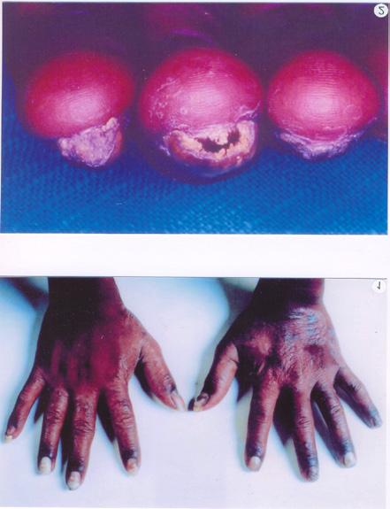 Distal subungual infection is the commonest pattern and involves nail bed and underside of nail in distal portion.